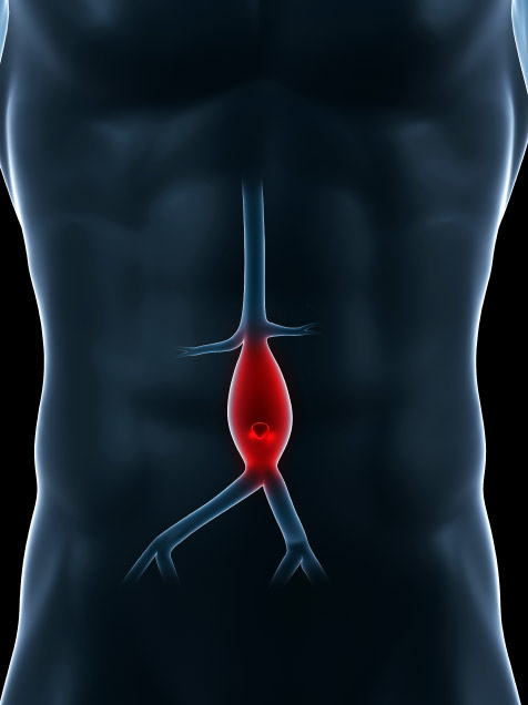 Aneurysmal Pathology Foundation